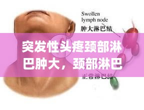突發(fā)性頭疼頸部淋巴腫大，頸部淋巴結(jié)疼頭疼 
