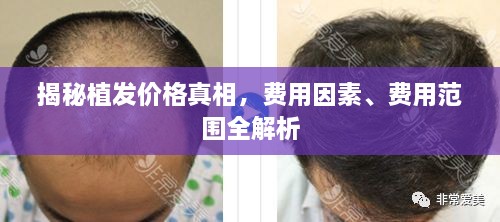 揭秘植發(fā)價格真相，費用因素、費用范圍全解析